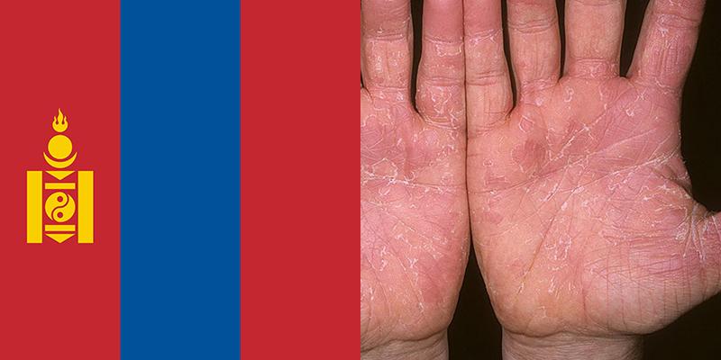Skin Disease in Mongolia